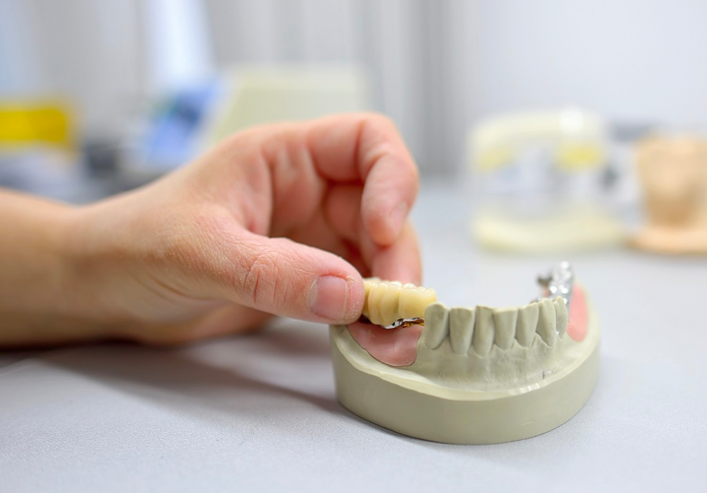 Dickson Street Dental|Crowns and Bridges