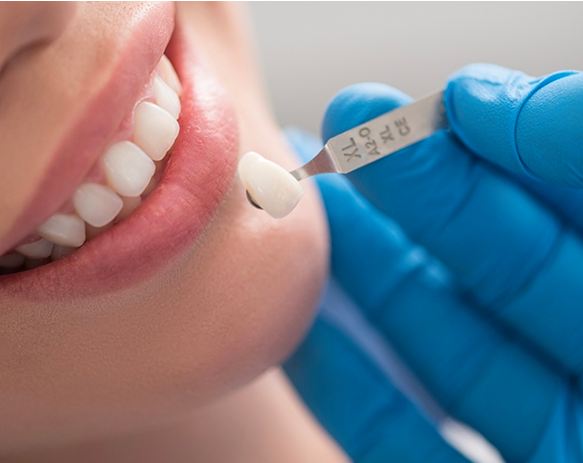 Dickson Street Dental|Crowns and Bridges