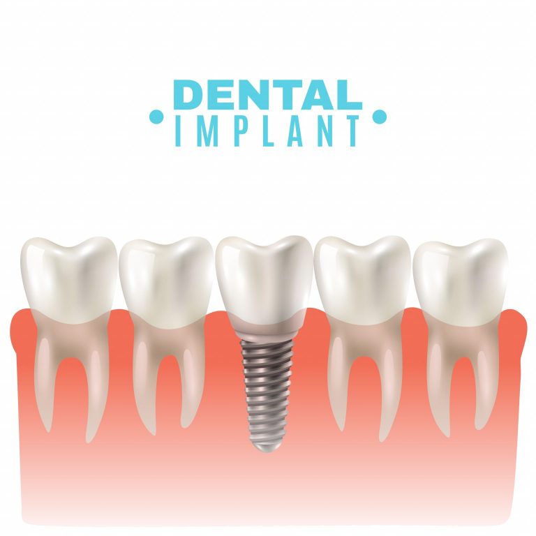 Dickson Street Dental | 5 Vital Tips for Aftercare and Recovery after a Dental Implant Procedure - Dickson Street Dental
