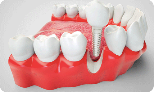 Dickson Street Dental|Early Release Of Super