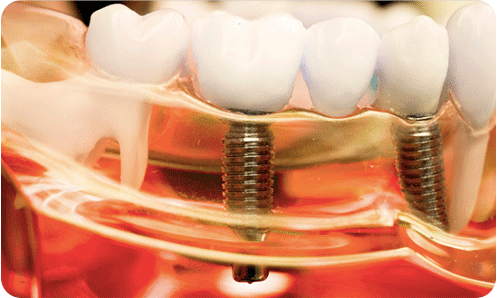 Dickson Street Dental|Early Release Of Super