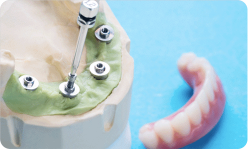 Dickson Street Dental|Early Release Of Super