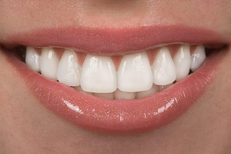 Dental Veneers in Mount Waverley